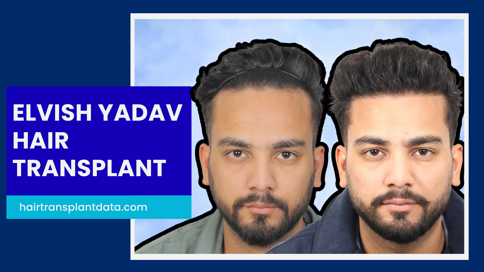 Elvish Yadav Hair Transplant