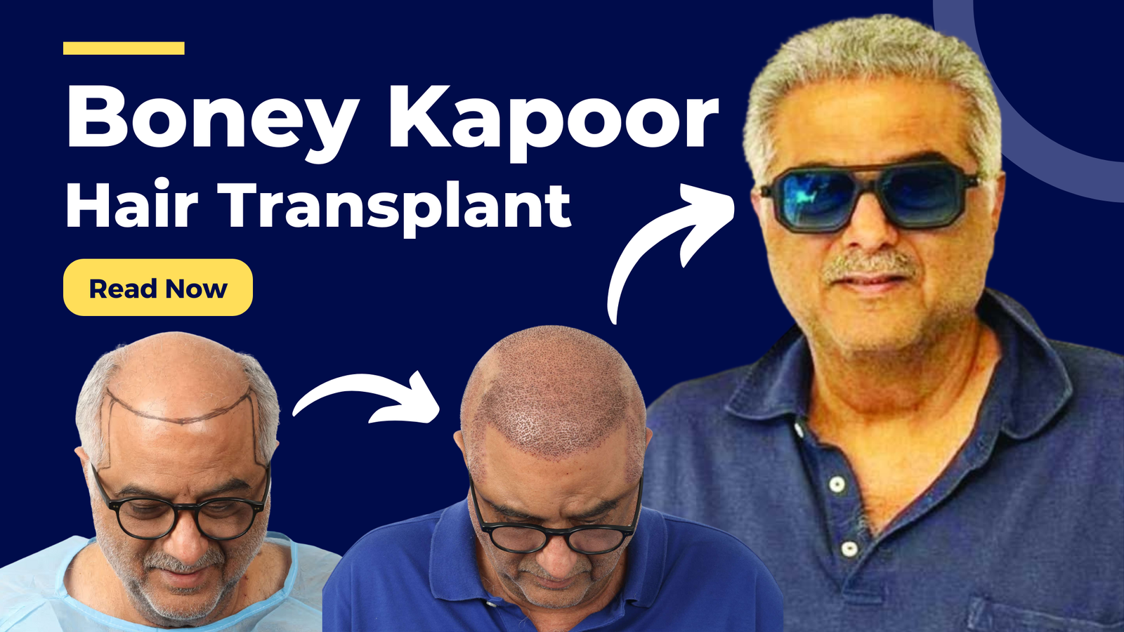 Boney Kapoor Hair Transplant